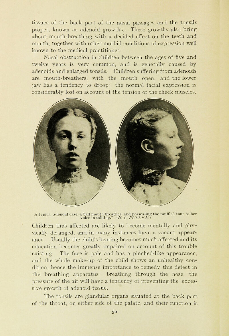 tissues of the back part of the nasal passages and the tonsils proper, known as adenoid growths. These growths also bring about mouth-breathing with a decided effect on the teeth and mouth, together with other morbid conditions of expression well known to the medical practitioner. Nasal obstruction in children between the ages of five and twelve years is very common, and is generally caused b}^ adenoids and enlarged tonsils. Children suffering from adenoids are mouth-breathers, with the mouth open, and the lower jaw has a tendency to droop; the normal facial expression is considerably lost on account of the tension of the cheek muscles. A typit-a adenoid case, a bad mouth breather, and possessing the m\ift'.ed tone to hci- voice in talliing.—(//. L. PVLLEN.) Children thus affected are likety to become mentally and phy- sicallv deranged, and in many instances have a vacant appear- ance. Usually the child's hearing becomes much affected and its education becomes greatly impaired on account of this trouble existing. The face is pale and has a pinched-like appearance, and the whole make-up of the child shows an unhealthy con- dition, hence the immense importance to remed}' this defect in the breathing apparatus; breathing through the nose, the pressure of the air will have a tendency of preventing the exces- sive growth of adenoid tissue. The tonsils are glandular organs situated at the back part of the throat, on either side of the palate, and their function is so