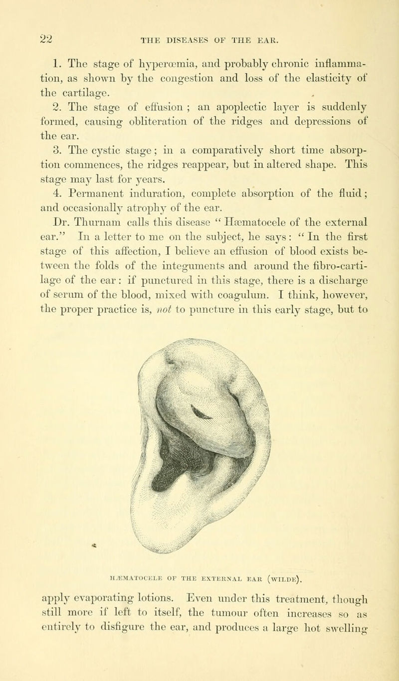 1. The stage of hyperemia, and probably chronic inflamma- tion, as shown by the congestion and loss of the elasticity of the cartilage. 2. The stage of effusion ; an apoplectic layer is suddenly formed, causing obliteration of the ridges and depressions of the ear. 3. The cystic stage; in a comparatively short time absorp- tion commences, the ridges reappear, but in altered shape. This stage may last for years. 4. Permanent induration, complete absorption of the fluid; and occasionally atrophy of the ear. Dr. Thurnam calls this disease  Haomatocele of the external ear. In a letter to me on the subject, he says:  In the first stage of this affection, I believe an effusion of blood exists be- tween the folds of the integuments and around the fibro-carti- lage of the ear: if punctured in this stage, there is a discharge of serum of the blood, mixed with coagulum. I think, however, the proper practice is, not to puncture in this early stage, but to HEMATOCELE OF THE EXTERNAL EAR (wILDe). apply evaporating lotions. Even under this treatment, though still more if left to itself, the tumour often increases so as entirely to disfigure the ear, and produces a large hot swelling