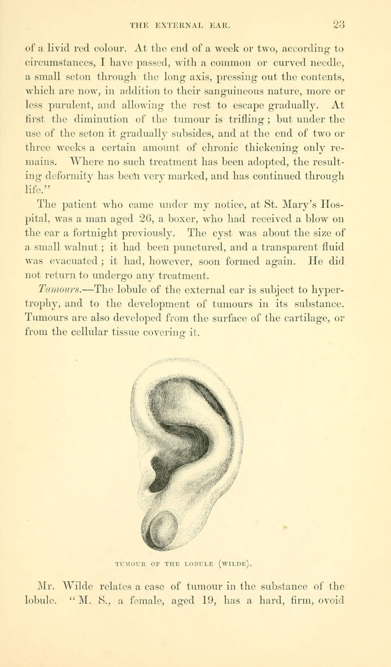 of a livid red colour. At the cud of a week or two, according' to circumstances, I have passed, with a common or curved needle, a small seton through the long axis, pressing- out the contents, which are now, in addition to their sanguineous nature, more or less purulent, and allowing the rest to escape gradually. At first the diminution of the tumour is trifling ; but under the use of the seton it gradually subsides, and at the end of two or time weeks a certain amount of chronic thickening only re- mains. Where no such treatment has been adopted, the result- ing deformity has been very marked, and has continued through life. The patient who came under my notice, at St. Mary's Hos- pital, was a man aged 26, a boxer, who had received a blow on the ear a fortnight previously. The cyst was about the size of a small walnut ; it had been punctured, and a transparent fluid was evacuated; it had, however, soon formed again. He did not return to undergo any treatment. Tumours.—The lobule of the external ear is subject to hyper- trophy, and to the development of tumours in its substance. Tumours are also developed from the surface of the cartilage, or from the cellular tissue coverina- it. TUMOUR OF THE LOBULE (WILDE). Mr. Wilde relates a case of tumour in the substance of the lobule.  M. S., a female, aged 19, has a hard, firm, ovoid