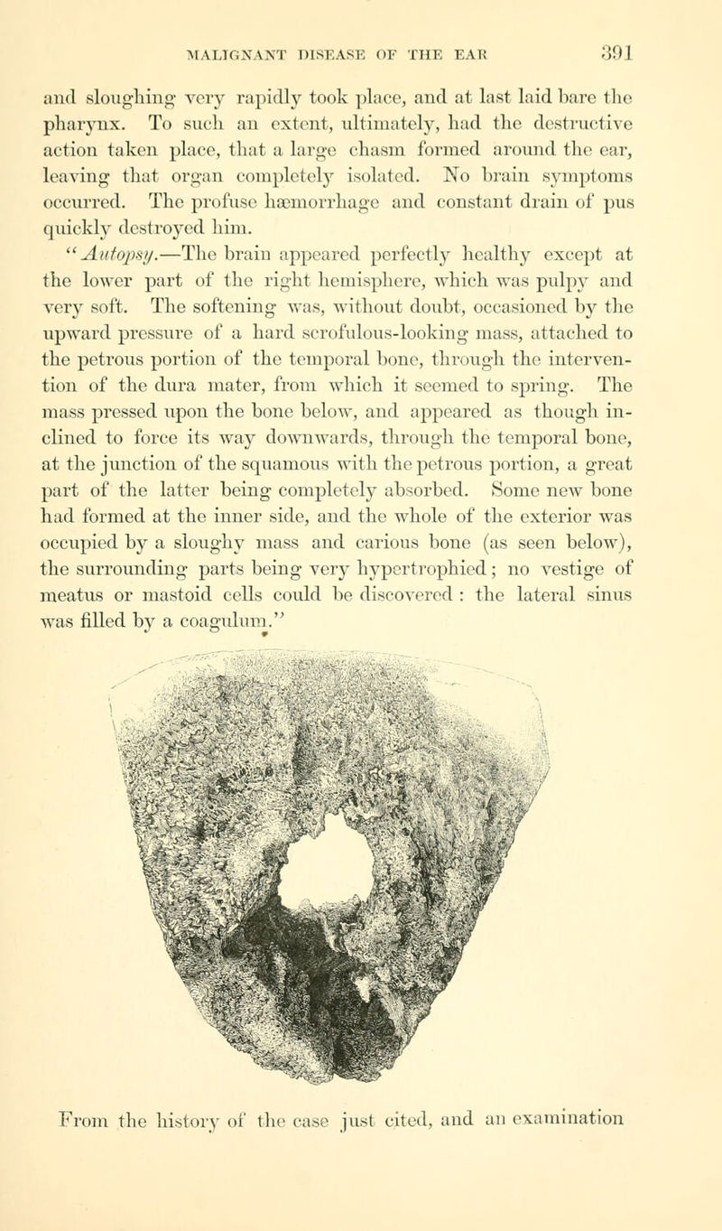 and sloughing very rapidly took place, and at last laid hare the pharynx. To such an extent, ultimately, had the destructive action taken place, that a large chasm formed around the ear, leaving that organ completely isolated. No hrain symptoms occurred. The profuse haemorrhage and constant drain of pus quickly destroyed him. Autopsy.—The brain appeared perfectly healthy except at the lower part of the right hemisphere, which was pulpy and very soft. The softening was, without doubt, occasioned by the upward pressure of a hard scrofulous-looking mass, attached to the petrous portion of the temporal bone, through the interven- tion of the dura mater, from which it seemed to spring. The mass pressed upon the bone below, and appeared as though in- clined to force its way downwards, through the temporal bone, at the junction of the squamous with the petrous portion, a great part of the latter being completely absorbed. Some new bone had formed at the inner side, and the whole of the exterior was occupied by a sloughy mass and carious bone (as seen below), the surrounding parts being very hypertrophied; no vestige of meatus or mastoid cells could be discovered : the lateral sinus was filled by a coagulum. fl:<XAr':--%. %i m-fi From the history of the case just cited, and an examination