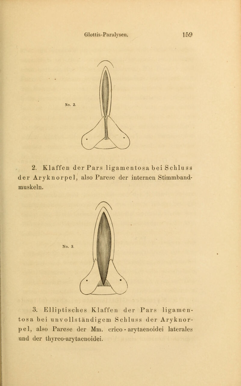 2. Klaffen der Pars ligamentosa bei Schluss der Aryknorpel, also Parese der internen Stimmband- muskeln. No. 3. Elliptisches Klaffen der Pars ligamen- tosa bei unvollständigem Schluss der Aryknor- pel, also Parese der Mm. crico - arytaenoidei laterales und der thyreo-arytaenoidei.