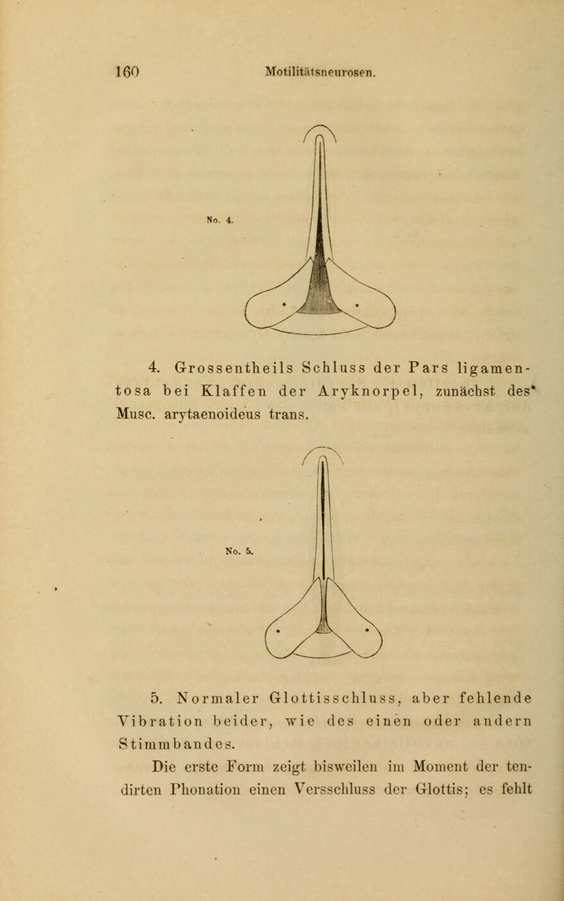 No. 4. 4. Grossentheils Schluss der Pars ligamen- tosa bei Klaffen der Aryknorpel, zunächst des Muse, arytaenoideus trans. No. &. 5. Normaler Glottisschluss, aber fehlende Vibration beider, wie des einen oder andern Stimmbandcs. Die erste Form zeigt bisweilen im Moment der ten- dirten Phonation einen Versschluss der Glottis; es fehlt