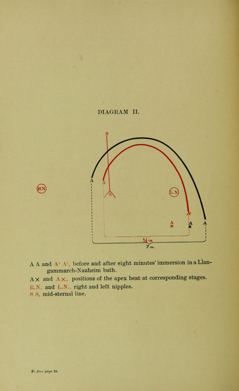 DIAGRAM II. 7 IN. A A and A1 A1, before and after eight minutes'immersion inaLlan- gammarch-Kauheim bath. A X and A x. positions of the apex beat at corresponding stages. K.N. and L.N., right and left nipples. S S, mid-sternal line. Tfi fair jiai/e 19.