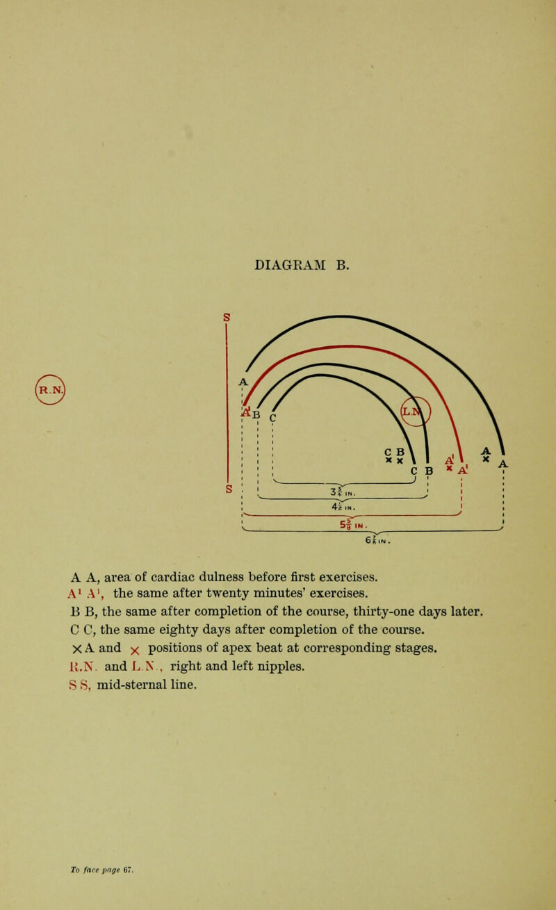 A A, area of cardiac dulness before first exercises. A1 A', the same after twenty minutes' exercises. B B, the same after completion of the course, thirty-one days later. C C, the same eighty days after completion of the course. X A and x positions of apex beat at corresponding stages. U.N. and L.N . right and left nipples. S S, mid-sternal line.