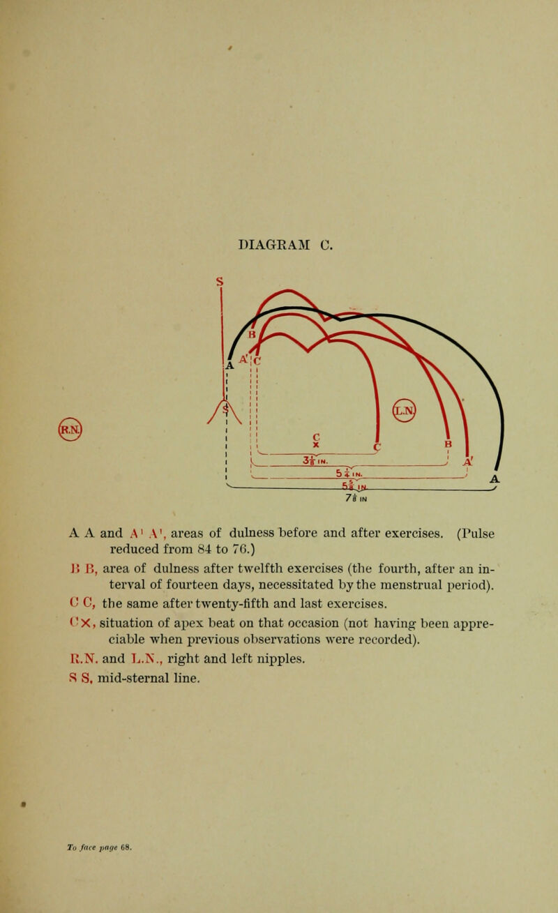 A A and A1 A\ areas of dulness before and after exercises. (Pulse reduced from 84 to 76.) B B, area of dulness after twelfth exercises (the fourth, after an in- terval of fourteen days, necessitated by the menstrual period). C C, the same after twenty-fifth and last exercises. I' X, situation of apex beat on that occasion (not having- been appre- ciable when previous observations were recorded). U.N. and L.N., right and left nipples. S S, mid-sternal line.