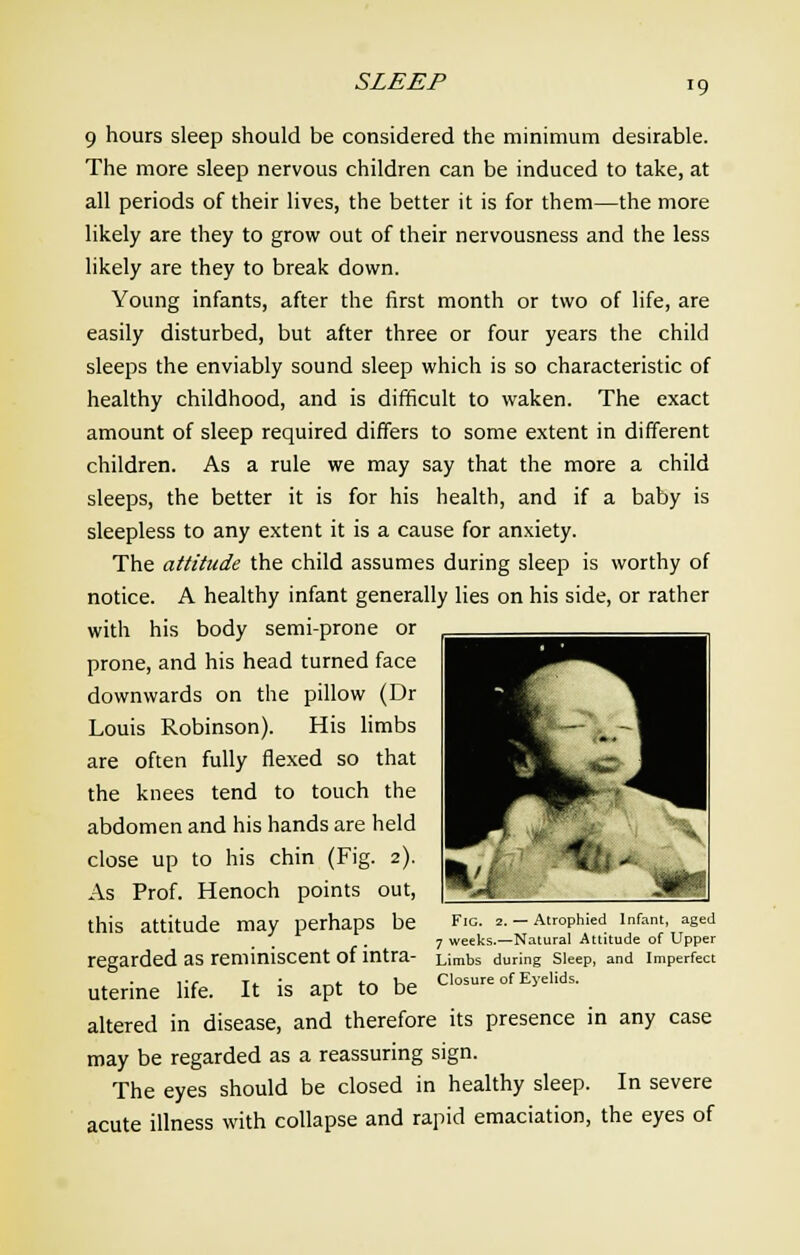 SLEEP 9 hours sleep should be considered the minimum desirable. The more sleep nervous children can be induced to take, at all periods of their lives, the better it is for them—the more likely are they to grow out of their nervousness and the less likely are they to break down. Young infants, after the first month or two of life, are easily disturbed, but after three or four years the child sleeps the enviably sound sleep which is so characteristic of healthy childhood, and is difficult to waken. The exact amount of sleep required differs to some extent in different children. As a rule we may say that the more a child sleeps, the better it is for his health, and if a baby is sleepless to any extent it is a cause for anxiety. The attitude the child assumes during sleep is worthy of notice. A healthy infant generally lies on his side, or rather with his body semi-prone or prone, and his head turned face downwards on the pillow (Dr Louis Robinson). His limbs are often fully flexed so that the knees tend to touch the abdomen and his hands are held close up to his chin (Fig. 2). As Prof. Henoch points out, this attitude may perhaps be regarded as reminiscent of intra- uterine life. It is apt to be altered in disease, and therefore its presence in any case may be regarded as a reassuring sign. The eyes should be closed in healthy sleep. In severe acute illness with collapse and rapid emaciation, the eyes of Fig. 2. — Atrophied Infant, aged 7 weeks.—Natural Attitude of Upper Limbs during Sleep, and Imperfect Closure of Eyelids.