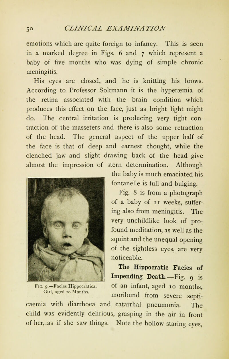 emotions which are quite foreign to infancy. This is seen in a marked degree in Figs. 6 and 7 which represent a baby of five months who was dying of simple chronic meningitis. His eyes are closed, and he is knitting his brows. According to Professor Soltmann it is the hyperemia of the retina associated with the brain condition which produces this effect on the face, just as bright light might do. The central irritation is producing very tight con- traction of the masseters and there is also some retraction of the head. The general aspect of the upper half of the face is that of deep and earnest thought, while the clenched jaw and slight drawing back of the head give almost the impression of stern determination. Although the baby is much emaciated his fontanelle is full and bulging. Fig. 8 is from a photograph of a baby of n weeks, suffer- ing also from meningitis. The very unchildlike look of pro- found meditation, as well as the squint and the unequal opening of the sightless eyes, are very noticeable. The Hippocratic Facies of Impending Death.—Fig. 9 is of an infant, aged 10 months, moribund from severe septi- caemia with diarrhoea and catarrhal pneumonia. The child was evidently delirious, grasping in the air in front of her, as if she saw things. Note the hollow staring eyes, Fig. 9.—Facies Hippocratica.