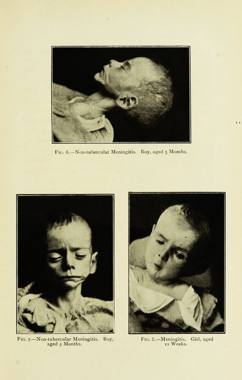 Fig. 6.—Non-tubercular Meningitis. Boy, aged 5 Months. Fig. 7.—Non-tubercular Meningitis. Boy, Fig. 8.—Meningitis. Girl, aged