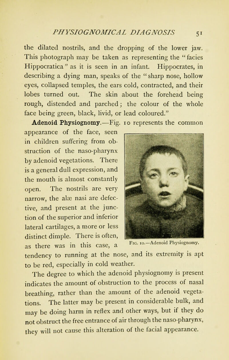 Si the dilated nostrils, and the dropping of the lower jaw. This photograph may be taken as representing the  facies Hippocratica as it is seen in an infant. Hippocrates, in describing a dying man, speaks of the  sharp nose, hollow eyes, collapsed temples, the ears cold, contracted, and their lobes turned out. The skin about the forehead being rough, distended and parched; the colour of the whole face being green, black, livid, or lead coloured. Adenoid Physiognomy.—Fig. 10 represents the common appearance of the face, seen in children suffering from ob- struction of the naso-pharynx by adenoid vegetations. There is a general dull expression, and the mouth is almost constantly open. The nostrils are very narrow, the alse nasi are defec- tive, and present at the junc- tion of the superior and inferior lateral cartilages, a more or less distinct dimple. There is often, as there was in this case, a tendency to running at the nose, and its extremity is apt to be red, especially in cold weather. The degree to which the adenoid physiognomy is present indicates the amount of obstruction to the process of nasal breathing, rather than the amount of the adenoid vegeta- tions. The latter may be present in considerable bulk, and may be doing harm in reflex and other ways, but if they do not obstruct the free entrance of air through the nasopharynx, they will not cause this alteration of the facial appearance. Fig. io.—Adenoid Physiognomy.