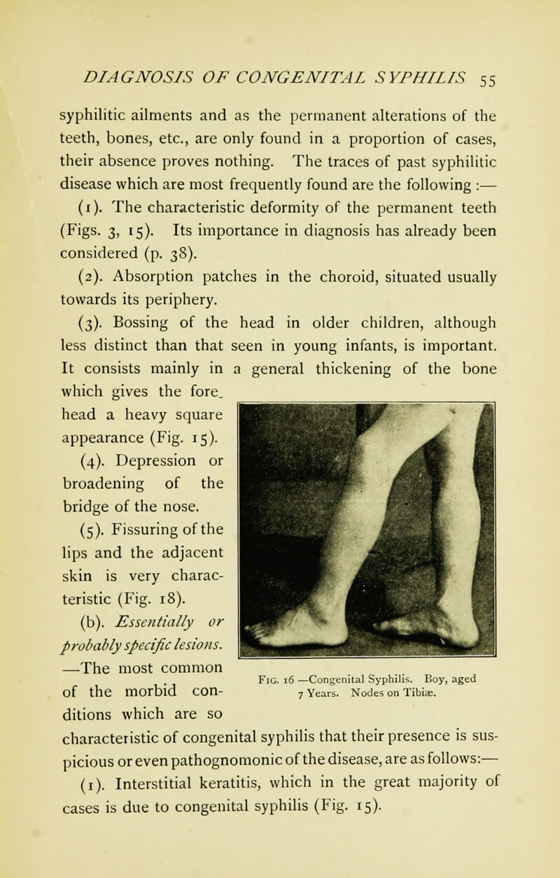 syphilitic ailments and as the permanent alterations of the teeth, bones, etc., are only found in a proportion of cases, their absence proves nothing. The traces of past syphilitic disease which are most frequently found are the following :— (1). The characteristic deformity of the permanent teeth (Figs. 3, 15). Its importance in diagnosis has already been considered (p. 38). (2). Absorption patches in the choroid, situated usually towards its periphery. (3). Bossing of the head in older children, although less distinct than that seen in young infants, is important. It consists mainly in a general thickening of the bone which gives the fore, head a heavy square appearance (Fig. 15). (4). Depression or broadening of the bridge of the nose. (5). Fissuring of the lips and the adjacent skin is very charac- teristic (Fig. 18). (b). Essentially or probably specific lesions. —The most common of the morbid con- ditions which are so characteristic of congenital syphilis that their presence is sus- picious or even pathognomonic of the disease, are as follows:— (1). Interstitial keratitis, which in the great majority of cases is due to congenital syphilis (Fig. 15). Fig. 16 —Congenital Syphilis. Boy, aged 7 Years. Nodes on Tibiae.