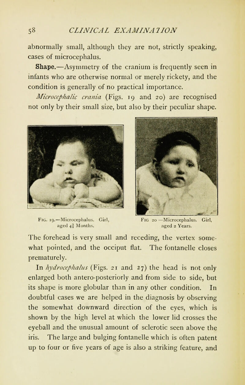abnormally small, although they are not, strictly speaking, cases of microcephalia. Shape.—Asymmetry of the cranium is frequently seen in infants who are otherwise normal or merely rickety, and the condition is generally of no practical importance. Microcephalic crania (Figs. 19 and 20) are recognised not only by their small size, but also by their peculiar shape. B -. ■£>*' JM k ^ Fig. 19.—Microcephalia. Girl, aged 4I Months. Fig 20 —Microcephalia. Girl, aged 2 Years. The forehead is very small and receding, the vertex some- what pointed, and the occiput flat. The fontanelle closes prematurely. In hydrocephalus (Figs. 21 and 27) the head is not only enlarged both antero-posteriorly and from side to side, but its shape is more globular than in any other condition. In doubtful cases we are helped in the diagnosis by observing the somewhat downward direction of the eyes, which is shown by the high level at which the lower lid crosses the eyeball and the unusual amount of sclerotic seen above the iris. The large and bulging fontanelle which is often patent up to four or five years of age is also a striking feature, and