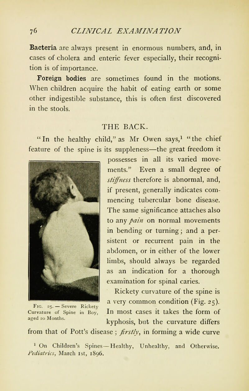 Bacteria are always present in enormous numbers, and, in cases of cholera and enteric fever especially, their recogni- tion is of importance. Foreign bodies are sometimes found in the motions. When children acquire the habit of eating earth or some other indigestible substance, this is often first discovered in the stools. THE BACK.  In the healthy child, as Mr Owen says,1  the chief feature of the spine is its suppleness—the great freedom it possesses in all its varied move- ments. Even a small degree of stiffness therefore is abnormal, and, if present, generally indicates com- mencing tubercular bone disease. The same significance attaches also to any pain on normal movements in bending or turning; and a per- sistent or recurrent pain in the abdomen, or in either of the lower limbs, should always be regarded as an indication for a thorough examination for spinal caries. Rickety curvature of the spine is a very common condition (Fig. 25). In most cases it takes the form of kyphosis, but the curvature differs from that of Pott's disease ; firstly, in forming a wide curve 1 On Children's Spines — Healthy, Unhealthy, and Otherwise. Pediatrics, March 1st, 1896. Fig. 25. — Severe Rickety Curvature of Spine in Boy, aged 20 Months.