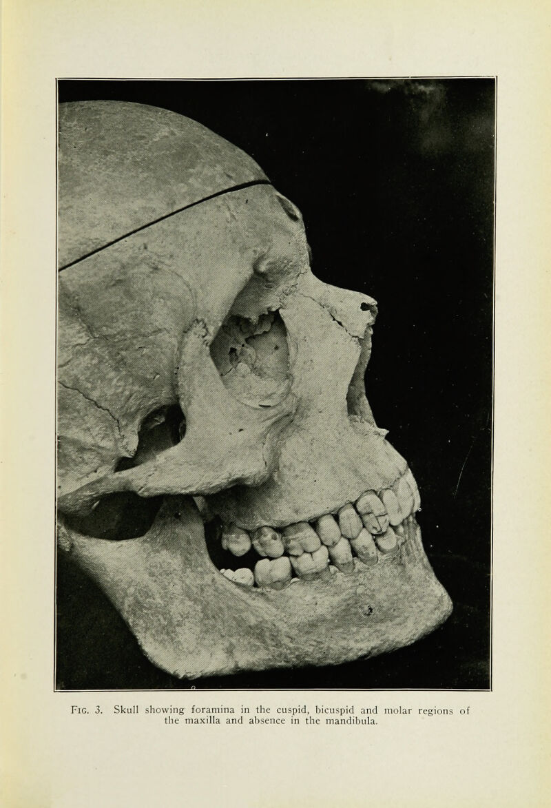 the maxilla and absence in the mandibula.