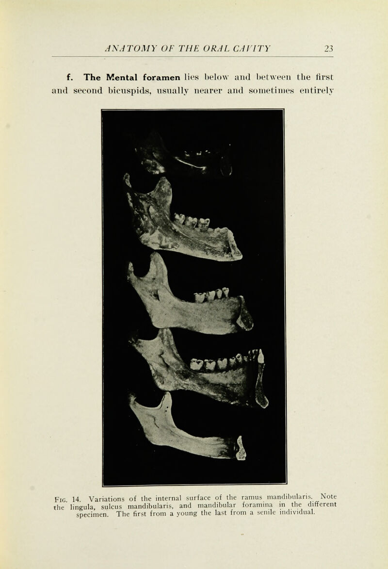 f. The Mental foramen lies below and ln'twecn the first ami second bicuspids, usually nearer and sometimes entirely Fig 14 Variations of the internal surface of the ramus niandihulans. Note the lingula, sulcus mandibularis, and mandibular foramina in the different specimen. The first from a young the last from a senile individual.