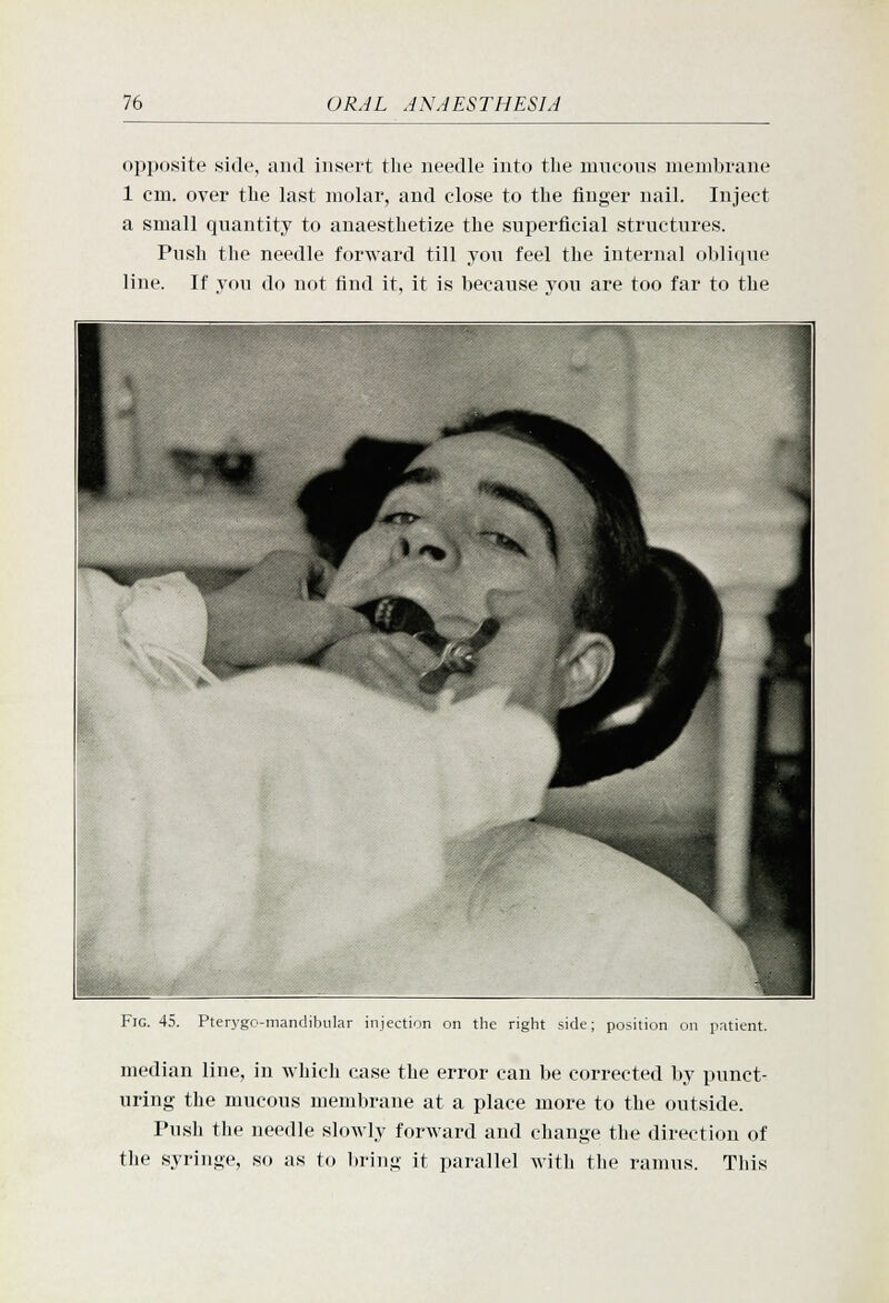 opposite side, and insert the needle into tlie mucous membrane 1 cm. over the last molar, and close to the finger nail. Inject a small quantity to anaesthetize the superficial structures. Push the needle forward till you feel the internal oblique line. If you do not find it, it is because you are too far to the I'K.. 45. Pti -mandibular injection on the right side; position on patient. median line, in which case the error can be corrected by punct- uring the mucous membrane at a place more to the outside. Push the needle slowly forward and change the direction of the syringe, so as to bring it parallel with the ramus. This