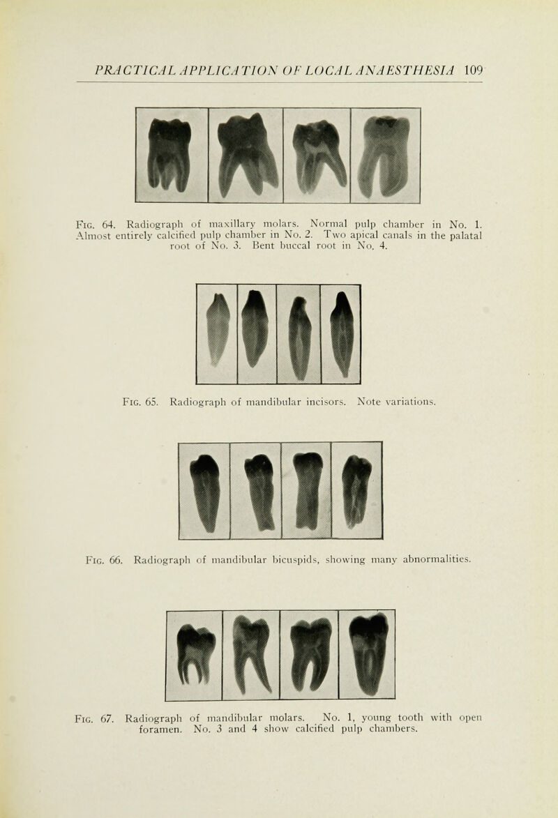 IMiM Fig. 64. Radiograph of maxillary molars. Normal pulp chamber in No. 1. Almost entirely calcified pulp chamber in No. 2. Two apical canals in the palatal root of No. 3. Bent buccal root in No. 4. MM Fig. 65. Radiograph of mandibular incisors. Note variations. nit Fig. 66. Radiograph of mandibular bicuspids, showing many abnormalities. tKfff Fig. 67. Radiograph of mandibular molars. No. 1, young tooth with open foramen. No. 3 and 4 show calcified pulp chambers.