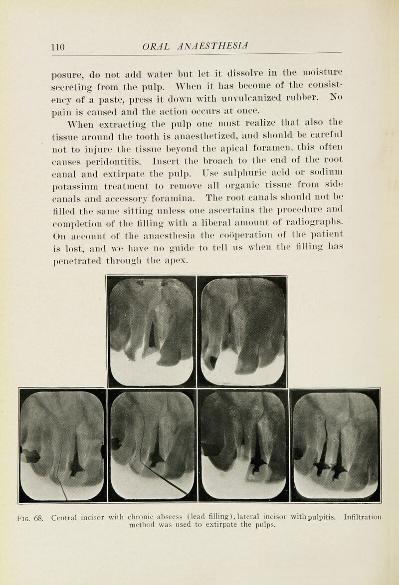 posiire, do not add Avater but let it dissolve in the moisture secreting from the pulp. When it has become of the consist- ency of a paste, press it down with unvulcanized rubber. No pain is caused and the action occurs at once. When extracting the pulp one must realize that also the tissue around the tooth is anaesthetized, and should be careful not to injure the tissue beyond the apical foramen, this often causes peridontitis. Insert the broach to the end of the root canal and extirpate tlie pulp. Use sulphuric acid or sodium potassium treatment to remove all organic tissue from side canals and accessory foramina. The root canals sliould not bo filled the same sitting unless one ascertains the procedure and completion of the filling with a liberal amount of radiographs. Oil account of the aiiaestlicsia the co()p('ration of tlie patient is lost, and we liave no guide to tell lis wlicu tlie filling has penetrated tlirough tlie a])ex. Fig. 68. Centra! incisor with chronic abscess (lead filling), lateral incisor with pulpitis. Infiltration method was used to extirpate the pulps.
