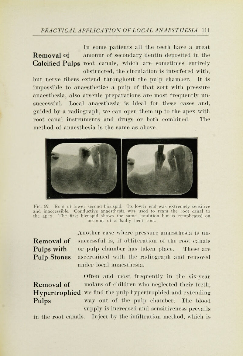 In some patients all tlio teeth have a great Removal of amount of secondary dentin deposited in the Calcified Pulps root canals, which are sometimes entirely obstructed, the circulation is interfered ^^■ith, Imt nerve tibers extend throughout the pulp chamber. It is impossible to anaesthetize a pulp of that sort witli pressure anaesthesia, also arsenic preparations are most frequently un- successful. Local anaesthesia is ideal for these cases and, guided by a radiograph, we can open them up to the apex with root canal instruments and drugs or l)otli comltined. Tlie method of anaesthesia is the same as above. Fig. 69. Root of lower second bicuspid. Its lower end was extremely sensitive and inaccessible. Conductive anaesthesia was used to ream the root canal to the ape.x. The first bicuspid shows the same condition but is complicated on account of a liadly bent root. Anotlier case where jircsstire anaesthesia is nn- Removal of successful is, if obliteration of tlie root canals Pulps with or pulp chamber lias taken place. These are Pulp Stones ascertained with the radiograpli and removed under local anacstliesia. Often and most fre(|ueutly in tlie six-year Removal of molai-s of children who neglected their teeth, Hypertrophied A\'e find tlie ])nl]) liy]iertroi)liied and extending Pulps \viiy out of tlie imlp clianiher. The blood supply is increased and sensitiveness ju'evails in the root canals. Inject bv tlie infijtraliou metliod, wliicli is