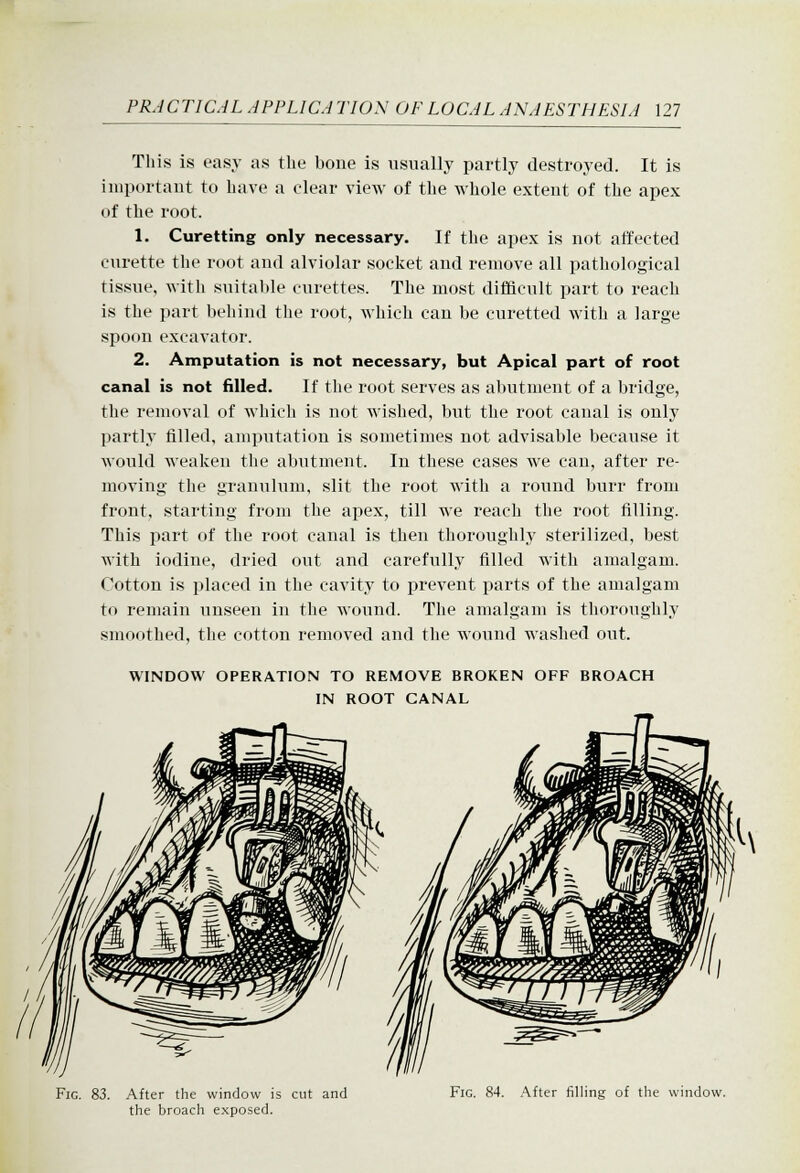This is easy as the bone is usually partly destroyed. It is important to have a clear view of the whole extent of the apex of the root. 1. Curetting only necessary. If the apex is not att'ected curette the root and alviolar socket and remove all pathological tissue, with suitable curettes. The most difficult part to reach is the part behind tlie root, which can be curetted with a large spoon excavator. 2. Amputation is not necessary, but Apical part of root canal is not filled. If the root serves as abutment of a bridge, the removal of which is not wished, but the root canal is only partly tilled, amputation is sometimes not advisable because it would weaken the abutment. In these cases we can, after re- moving the granulum, slit the root with a round burr from front, starting from the apex, till we reach the root filling. This part of the root canal is then thoroughly sterilized, best with iodine, dried out and carefully filled with amalgam. Cotton is placed in the cavity to prevent parts of the amalgam to remain unseen in the wound. The amalgam is thoroughly smoothed, the cotton removed and the wound washed out. WINDOW OPERATION TO REMOVE BROKEN OFF BROACH IN ROOT CANAL Fig. 83. After the window is cut and the broach exposed. Fig. 84. .\fter filling of the window.