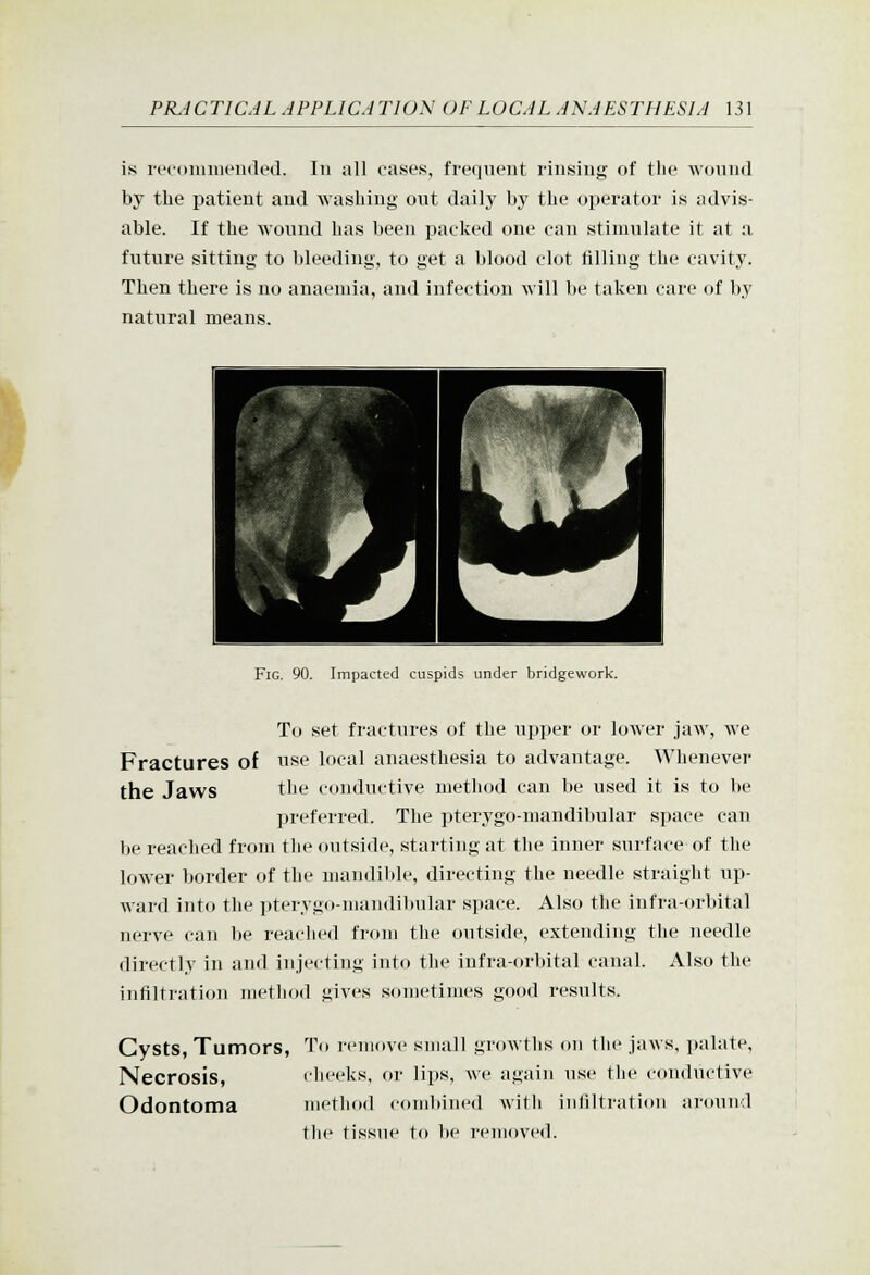 is ri'coniineiuled. In all cases, frequent rinsing of the wound by the patient and washing out daily by the operator is advis- able. If the wound has been packed one can stimulate it at a future sitting to bleeding, to get a blood clot filling the cavity. Then there is no anaemia, and infection will be taken care of by natural means. ) Fig. 90. Impacted cuspids under bridgework. To set fractures of the upper or lower jaw, we Fractures of nse local anaesthesia to advantage. Whenever the Jaws tbe conductive method can be used it is to be preferred. The pterygo-mandibular space can be reached from the outside, starting at the inner surface of the lower border of the niandil)le, directing the needle straight up- ward into the pterygo-mandibular space. Also the infra-orbital nerve can be reached from the outside, extending the needle directly in and injecting into the infra-orbital canal. Also the infiltration method gives sometimes good results. Cysts, Tumors, To remove small growths on the jaws, palate. Necrosis, dieeks, or lips, we again nse the conductive Odontoma method combined witli infiltration around the tissue to be removed.