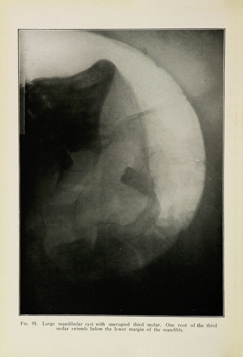 molar extends below the lower margin of the mandible.