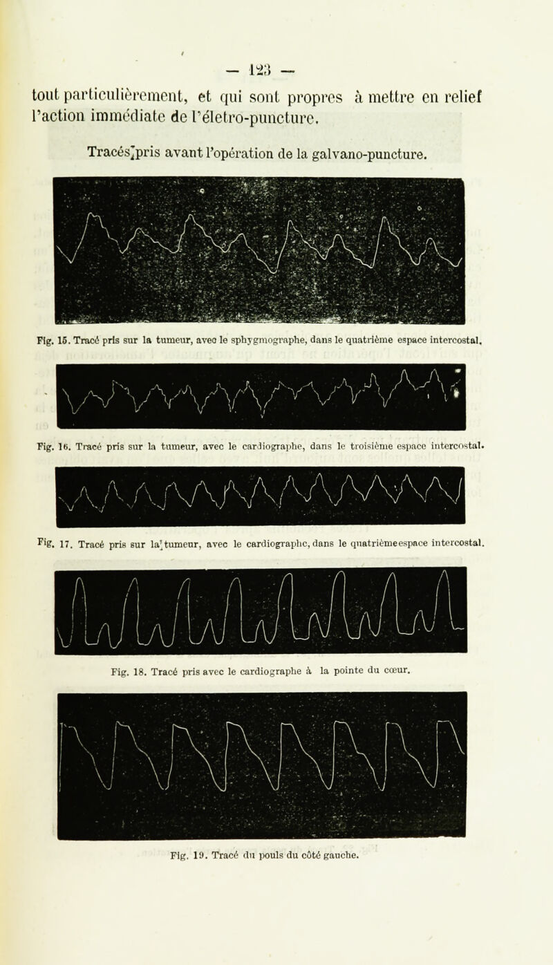 tout particulièrement, et qui sont propres à mettre en relief l'action immédiate de l'életro-puncture. Tracésjpris avant l'opération de la galvano-puncture. Fig. 15. Tracé pris sur la tumeur, aveo le sphygmographe, dans le quatrième espace intercostal. Fig. 16. Tracé pris sur la tumeur, avec le cardiographe, dans le troisième espace intercostal. Fig. 17. Tracé pris sur la'tumeur, avec le cardiographe, dans le quatrièmeespace intercostal. Fig. 18. Tracé pris avec le cardiographe à la pointe du cœur. Fig. 19. Tracé du pouls du côté gauche.