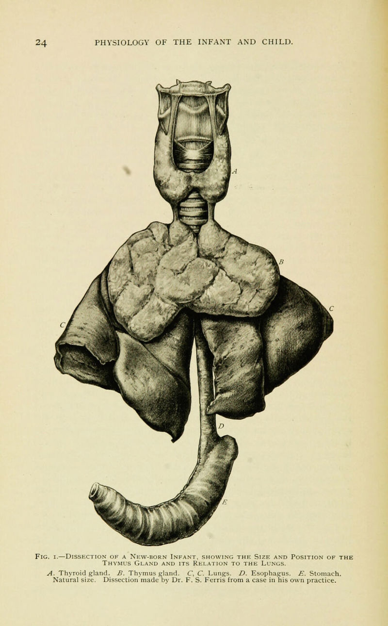 Fig. i.—Dissection of a New-born Infant, showing the Size and Position of the Thymus Gland and its Relation to the Lungs. A. Thyroid gland. B. Thymus gland. C, C. Lungs. D. Esophagus. E. Stomach. Natural size. Dissection made by Dr. F. S. Ferris from a case in his own practice.