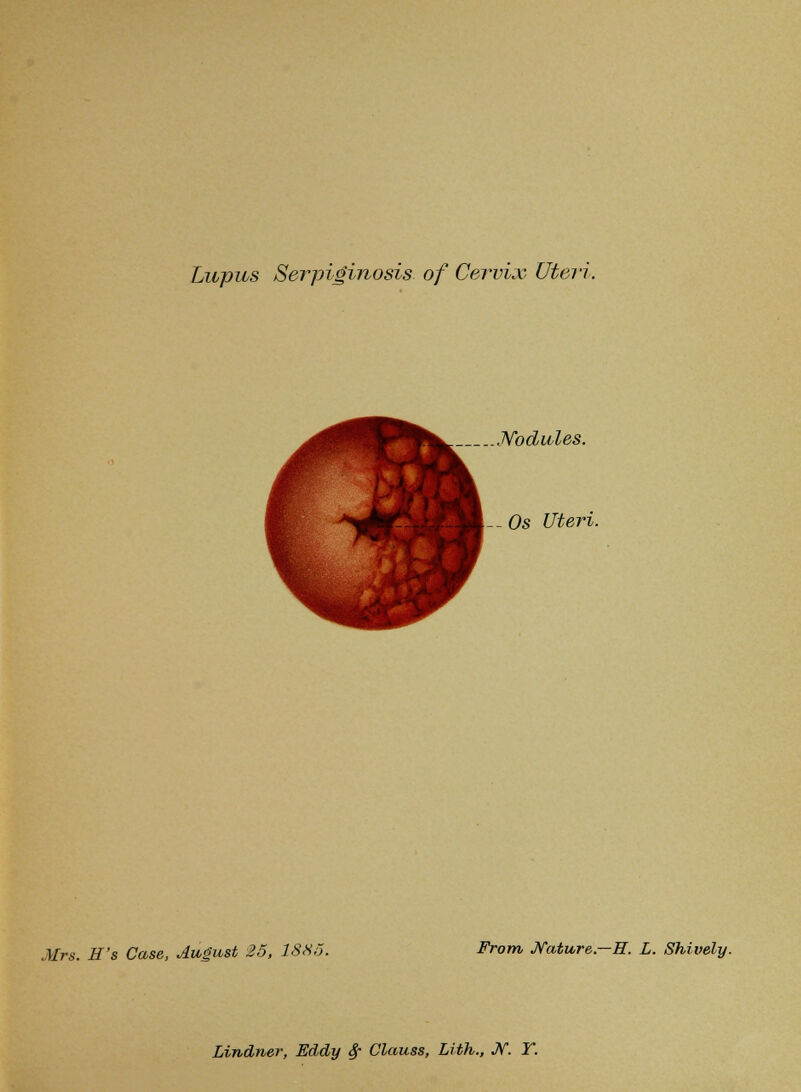 Lupus Serpiginosis of Cervix Uteri. Nodules. Os Uteri. Mrs. H's Case, August 25, 1885. From Nature—H. L. Shively. Lindner, Eddy $~ Clauss, Lith., Jf. Y.