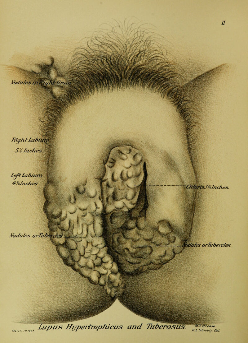 // .Vodu/es % TiiqhUabi, S/i/riches. Icftlabii/m 4-%/nches -,.0. ClrfQris,/%/ncht!s. . Vodu/es arTi/betFc/eg - J^mjflit/es orTuberc/es. Lupus Miipert/vphicus and Tuberosus hM-s Shively DeJ.