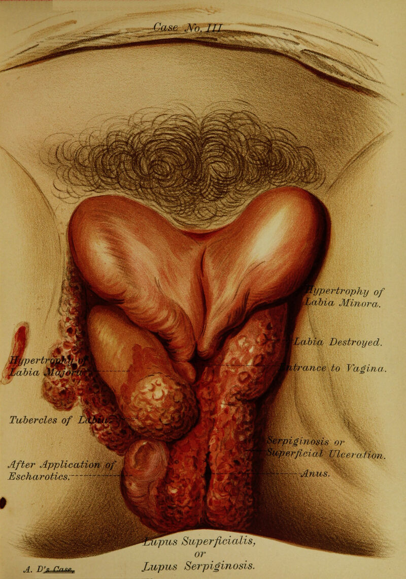 -^^yiu^ Tubercles of After Application oj Eschar otics. ypertrophy of abia Minora. abia Destroyed. prance to Vagina. ^Mtiginosis or Superficial UlceroHon. Anus. A. d: Superficiali or Jjupus Serpiginosis