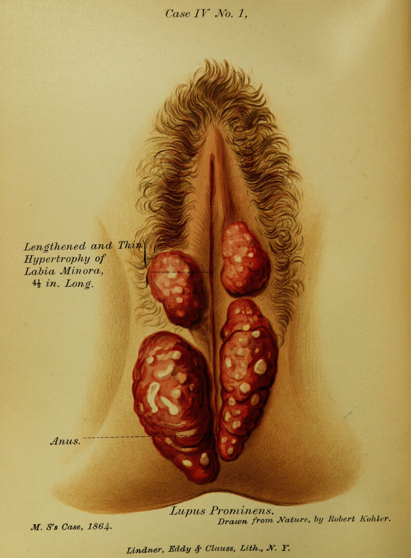 Lengthened and Thi^f Hypertrophy of Labia Minora, 4^ in. Long. Anus. M. S's Case, 1864- Lupus Prominens, Drawn from Nature, by Hubert Kvhlcr.