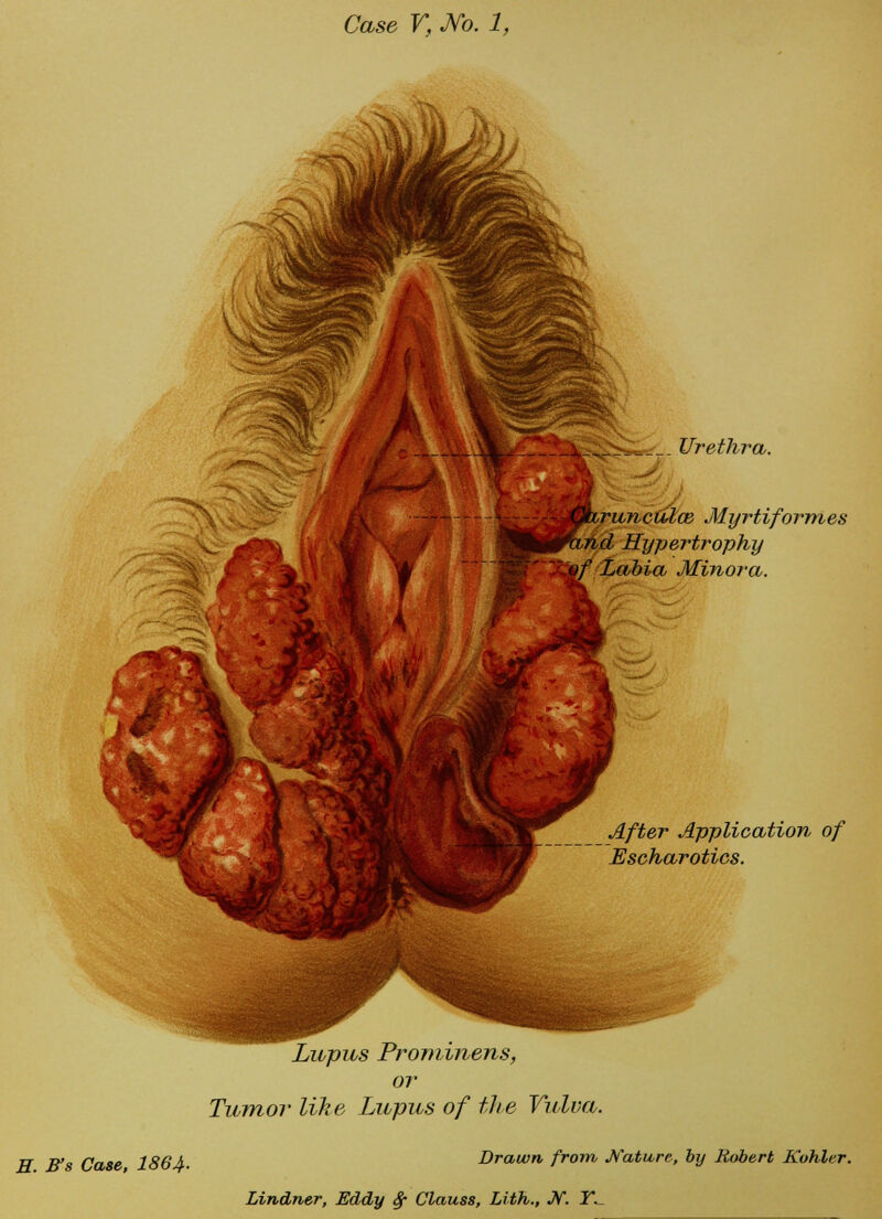 Urethra. runcatcB Myrtiformes nd Hypertrophy Labia Minora. After Application of Escharotics. Lupus Prominens, or Tumor like Lupus of the Vulva. H B's Case 186A. Drawn from Mature, by Robert K'ohler.