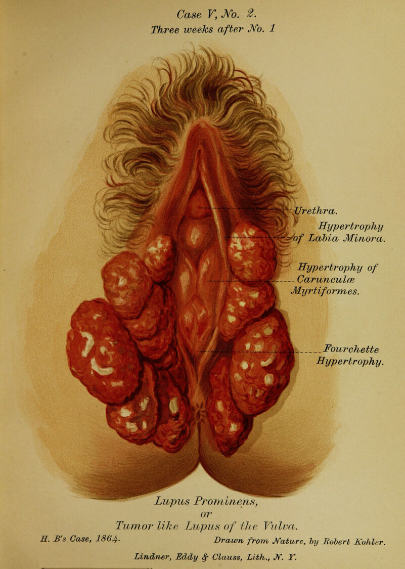 Three weeks after No. 1 Urethra. Hypertrophy ^of Labia Minora. Hypertrophy of CaruncuUe Myrtiformes. __Fourchette Hypertrophy. Lupus Prominens, or Tumor like Lupus of the Vulva. H. B's Case, I864. Drawn from, Nature, by Robert Kohlcr.