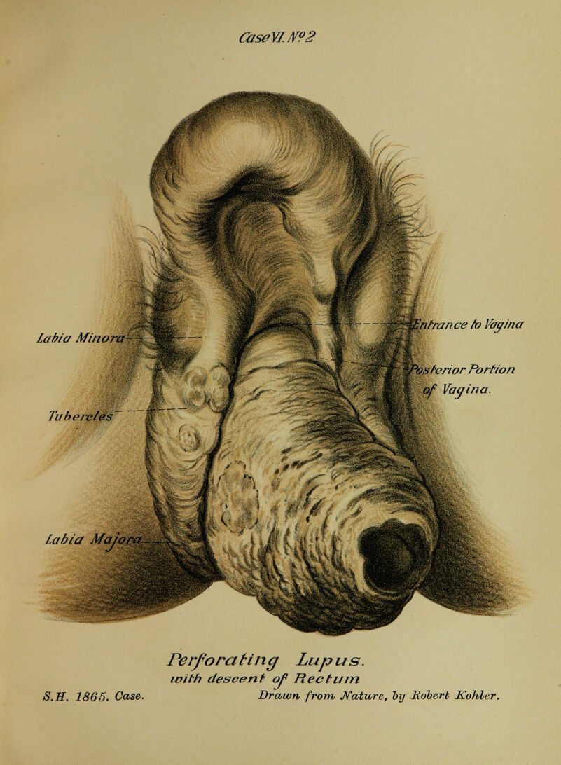 QiseW.N?2 Labia Minora— Tubercles' '^Entrance fo Vagina Labia Majora. b,sterior Portion of Vagina. Perfo/^a ting Lup u s. with descent ofi Rectum