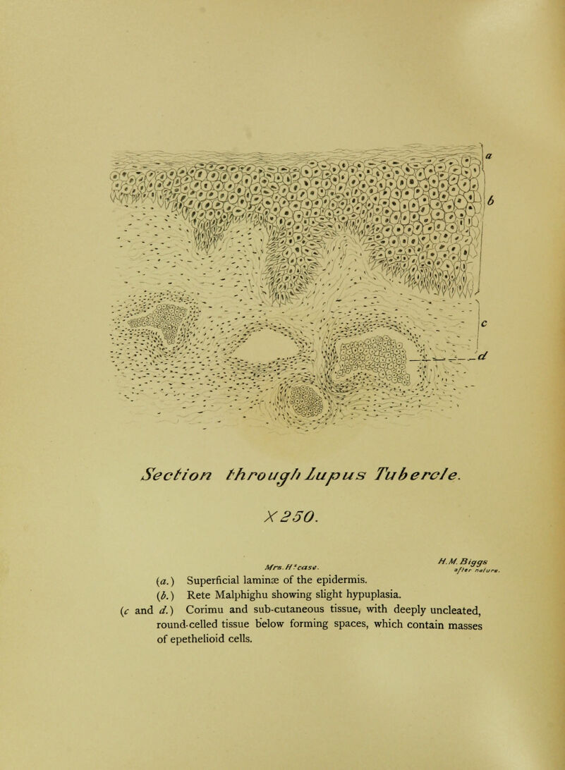 Section through lupus Tubercle. X250. Mrs. H'case. ,fl.?n.tur.. (a.) Superficial laminae of the epidermis. {b.) Rete Malphighu showing slight hypuplasia. (c and d.) Corimu and sub-cutaneous tissue, with deeply uncleated, round-celled tissue below forming spaces, which contain masses of epethelioid cells.