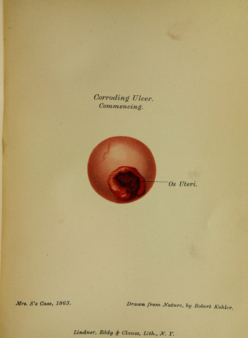 Corroding Ulcer. Commencing. Os Uteri. Mrs. S's Case, 1863. Drawn from Nature, by Robert Kohlcr Lindner, Eddy $• Clauss, Lith., JV. T.