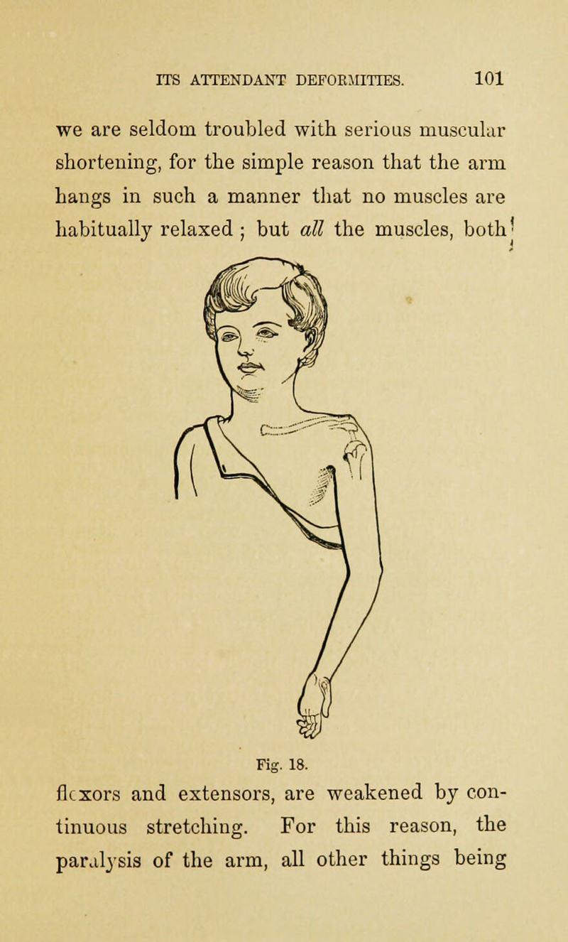 we are seldom troubled with serious muscular shortening, for the simple reason that the arm hangs in such a manner that no muscles are habitually relaxed ; but all the muscles, both' Fig. 18. flexors and extensors, are weakened by con- tinuous stretching. For this reason, the paralysis of the arm, all other things being