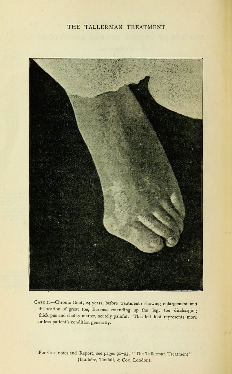 Case 2.—Chronic Gout, 24 years, before treatment: showing enlargement and dislocation of great toe, Eczema extending up the leg, toe discharging thick pus and chalky matter, acutely painful. This left foot represents more or less patient's condition generally. For Case notes and Report, see pages 9C-93, The Tallerman Treatment'