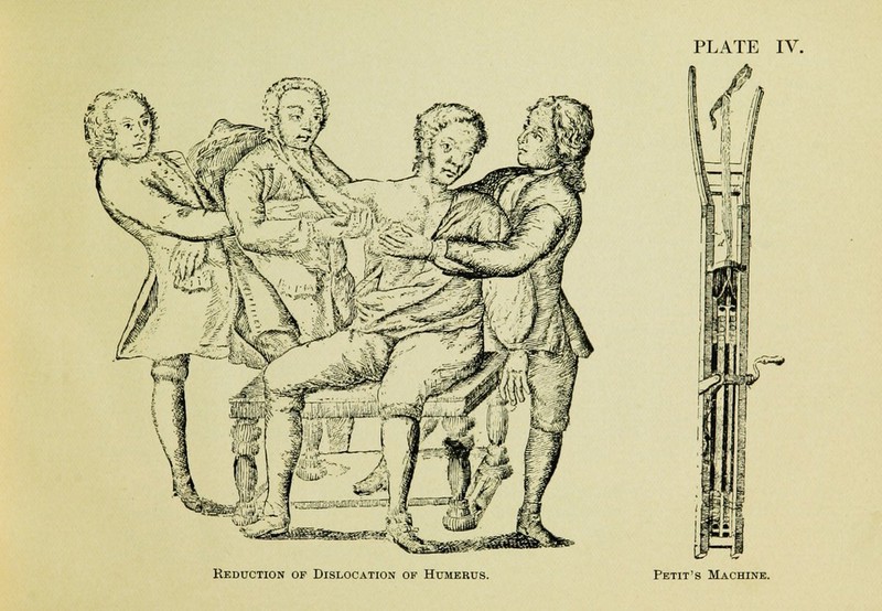 Reduction op Dislocation of Humerus. Petit's Machine.