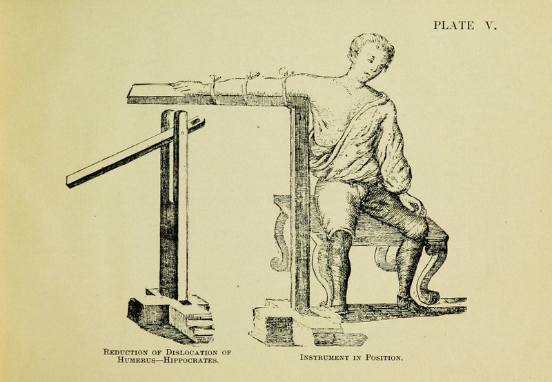 Reduction of Dislocation of Humerus—Hippocrates. Instrument in Position.