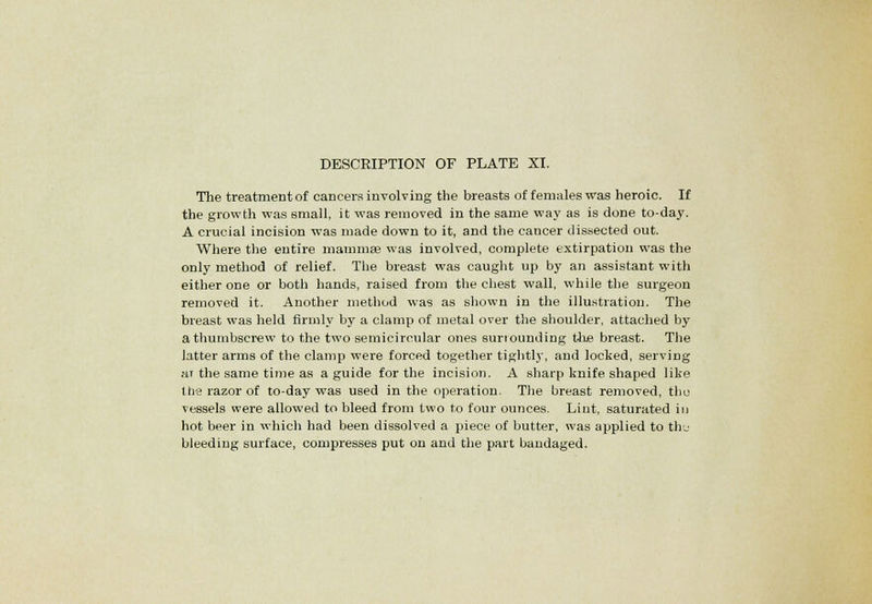 The treatment of cancers involving the breasts of females was heroic. If the growth was small, it was removed in the same way as is done to-day. A crucial incision was made down to it, and the cancer dissected out. Where the entire mammas was involved, complete extirpation was the only method of relief. The breast was caught up by an assistant with either one or both hands, raised from the chest wall, while the surgeon removed it. Another method was as shown in the illustration. The breast was held firmly by a clamp of metal over the shoulder, attached by a thumbscrew to the two semicircular ones suriounding the breast. The latter arms of the clamp were forced together tightly, and locked, serving ai the same time as a guide for the incision. A sharp knife shaped like the razor of to-day was used in the operation. The breast removed, tbu vessels were allowed to bleed from two to four ounces. Lint, saturated in hot beer in which had been dissolved a piece of butter, was applied to thu bleeding surface, compresses put on and the part bandaged.