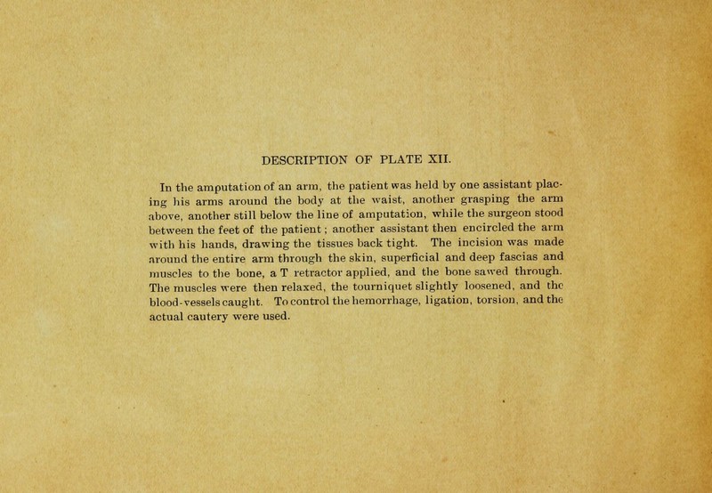 In the amputation of an arm, the patient was held by one assistant plac- ing his arms around the body at the waist, another grasping the arm above, another still below the line of amputation, while the surgeon stood between the feet of the patient; another assistant then encircled the arm with his hands, drawing the tissues back tight. The incision was made around the entire arm through the skin, superficial and deep fascias and muscles to the bone, a T retractor applied, and the bone sawed through. The muscles were then relaxed, the tourniquet slightly loosened, and the blood-vessels caught. To control the hemorrhage, ligation, torsion, and the actual cautery were used.