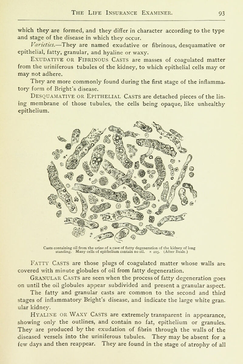 which they are formed, and they differ in character according to the type and stage of the disease in which they occur. Varieties.—They are named exudative or fibrinous, desquamative or epithelial, fatty, granular, and hyaline or waxy. Exudative or Fibrinous Casts are masses of coagulated matter from the uriniferous tubules of the kidney, to which epithelial cells may or may not adhere. They are more commonly found during the first stage of the inflamma- tory form of Bright's disease. Desquamative or Epithelial Casts are detached pieces of the lin- ing membrane of those tubules, the cells being opaque, like unhealthy epithelium. Casts containing oil from the urine of a case of fatty degeneration of the kidney of long standing. Many cells of epithelium contain no oil. x 215. (After Beale.) Fatty Casts are those plugs of coagulated matter whose walls are covered with minute globules of oil from fatty degeneration. Granular Casts are seen when the process of fatty degeneration goes on until the oil globules appear subdivided and present a granular aspect. The fatty and granular casts are common to the second and third stages of inflammatory Bright's disease, and indicate the large white gran, ular kidney. Hyaline or Waxy Casts are extremely transparent in appearance, showing only the outlines, and contain no fat, epithelium or granules. They are produced by the exudation of fibrin through the walls of the diseased vessels into the uriniferous tubules. They may be absent for a few days and then reappear. They are found in the stage of atrophy of all