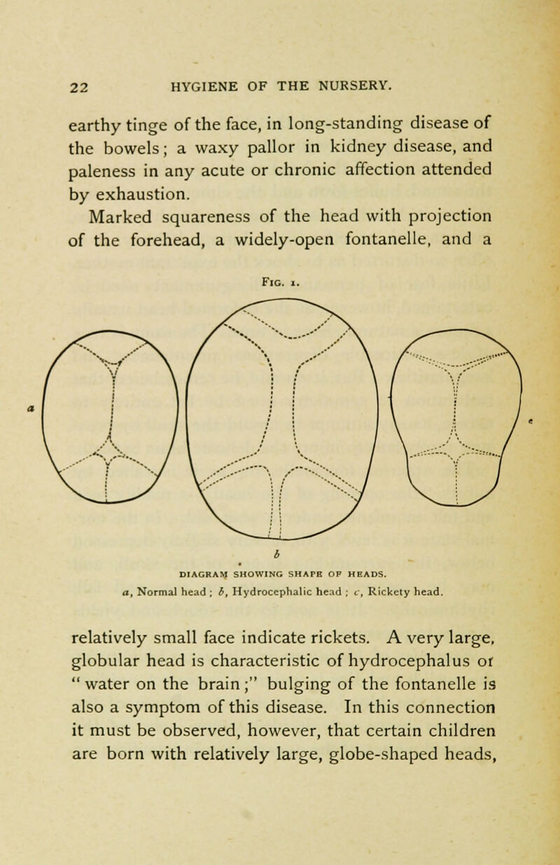 earthy tinge of the face, in long-standing disease of the bowels; a waxy pallor in kidney disease, and paleness in any acute or chronic affection attended by exhaustion. Marked squareness of the head with projection of the forehead, a widely-open fontanelle, and a Fig. DIAGRAM SHOWING SHAPE OF HEADS. a. Normal head ; b. Hydrocephalic head ; c. Rickety head. relatively small face indicate rickets. A very large, globular head is characteristic of hydrocephalus or  water on the brain ; bulging of the fontanelle is also a symptom of this disease. In this connection it must be observed, however, that certain children are born with relatively large, globe-shaped heads,