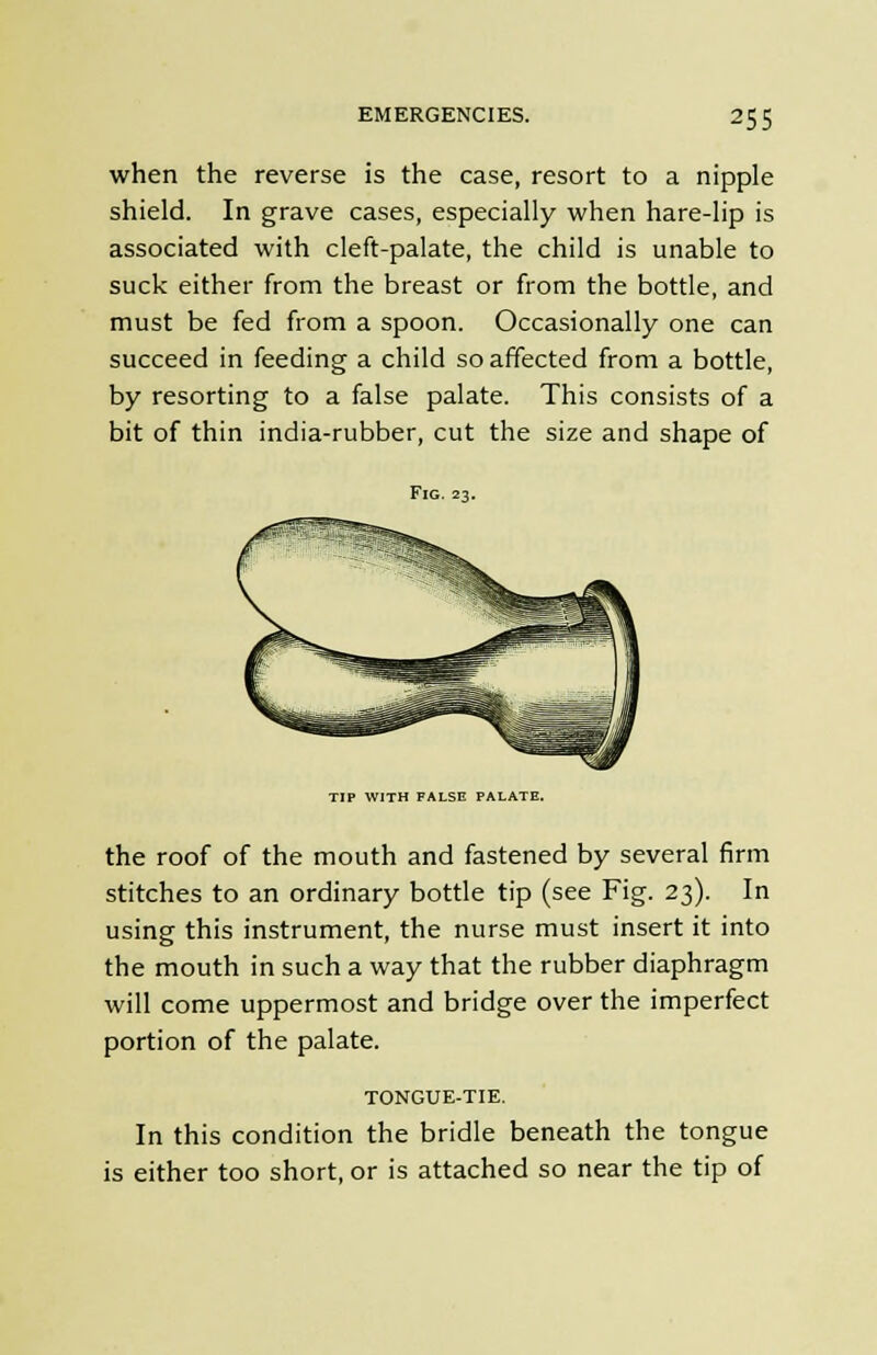 when the reverse is the case, resort to a nipple shield. In grave cases, especially when hare-lip is associated with cleft-palate, the child is unable to suck either from the breast or from the bottle, and must be fed from a spoon. Occasionally one can succeed in feeding a child so affected from a bottle, by resorting to a false palate. This consists of a bit of thin india-rubber, cut the size and shape of Fig. 23. TIP WITH FALSE PALATE. the roof of the mouth and fastened by several firm stitches to an ordinary bottle tip (see Fig. 23). In using this instrument, the nurse must insert it into the mouth in such a way that the rubber diaphragm will come uppermost and bridge over the imperfect portion of the palate. TONGUE-TIE. In this condition the bridle beneath the tongue is either too short, or is attached so near the tip of