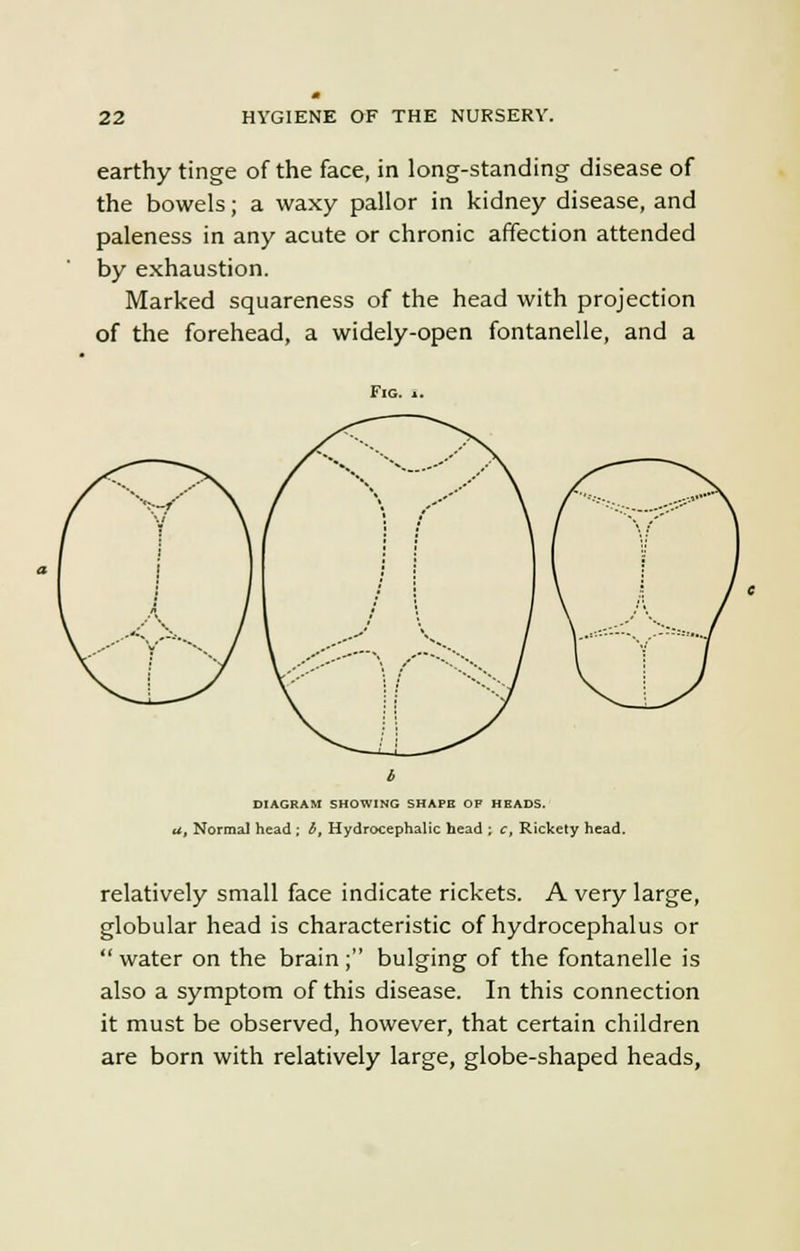 earthy tinge of the face, in long-standing disease of the bowels; a waxy pallor in kidney disease, and paleness in any acute or chronic affection attended by exhaustion. Marked squareness of the head with projection of the forehead, a widely-open fontanelle, and a Fig. DIAGRAM SHOWING SHAPE OF HBADS. a, Normal head ; b, Hydrocephalic head ; c, Rickety head. relatively small face indicate rickets. A very large, globular head is characteristic of hydrocephalus or water on the brain ; bulging of the fontanelle is also a symptom of this disease. In this connection it must be observed, however, that certain children are born with relatively large, globe-shaped heads,