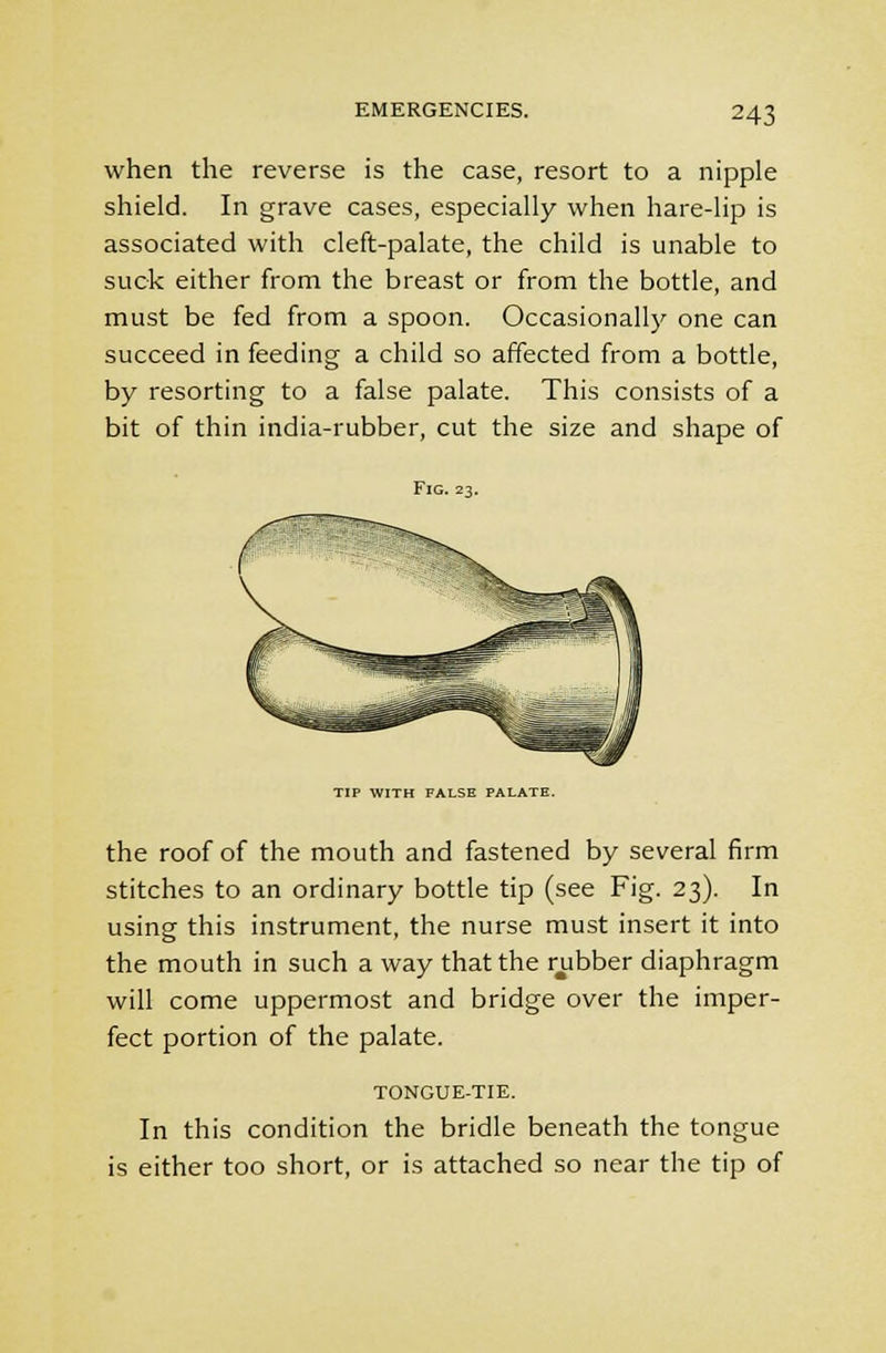 when the reverse is the case, resort to a nipple shield. In grave cases, especially when hare-lip is associated with cleft-palate, the child is unable to suck either from the breast or from the bottle, and must be fed from a spoon. Occasionally one can succeed in feeding a child so affected from a bottle, by resorting to a false palate. This consists of a bit of thin india-rubber, cut the size and shape of Fig. 23. TIP WITH FALSE PALATE. the roof of the mouth and fastened by several firm stitches to an ordinary bottle tip (see Fig. 23). In using this instrument, the nurse must insert it into the mouth in such a way that the rubber diaphragm will come uppermost and bridge over the imper- fect portion of the palate. TONGUE-TIE. In this condition the bridle beneath the tongue is either too short, or is attached so near the tip of