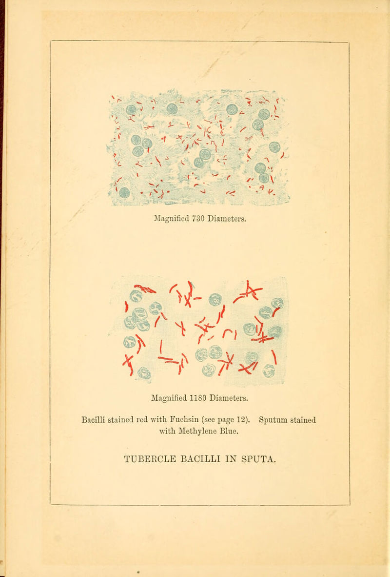 i K v 5 .<*S r 1 '.iJ$L'\l '- < \ J 1 * / f /-^- \ Magnified 730 Diameters. >^#v * ./ <g Magnified 1IS0 Diameters. Bacilli stained red with Fuclisin (see page 12). Sputum stained with Methylene Blue. TUBERCLE BACILLI IN SPUTA.