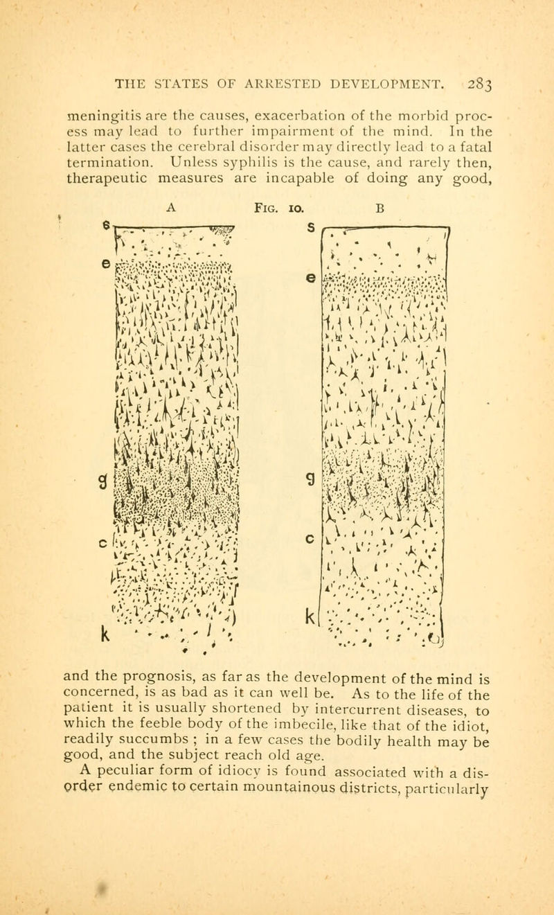 meningitis are the causes, exacerbation of the morbid proc- ess may lead to further impairment of the mind. In the latter cases the cerebral disorder may directly lead to a fatal termination. Unless syphilis is the cause, and rarely then, therapeutic measures are incapable of doing any good, A Fig. 10. B W Ft-?—7—7-—'SS A 1 i *, *.fj and the prognosis, as far as the development of the mind is concerned, is as bad as it can well be. As to the life of the patient it is usually shortened by intercurrent diseases, to which the feeble body of the imbecile, like that of the idiot, readily succumbs ; in a few cases the bodily health may be good, and the subject reach old age. A peculiar form of idiocy is found associated with a dis- order endemic to certain mountainous districts, particularly