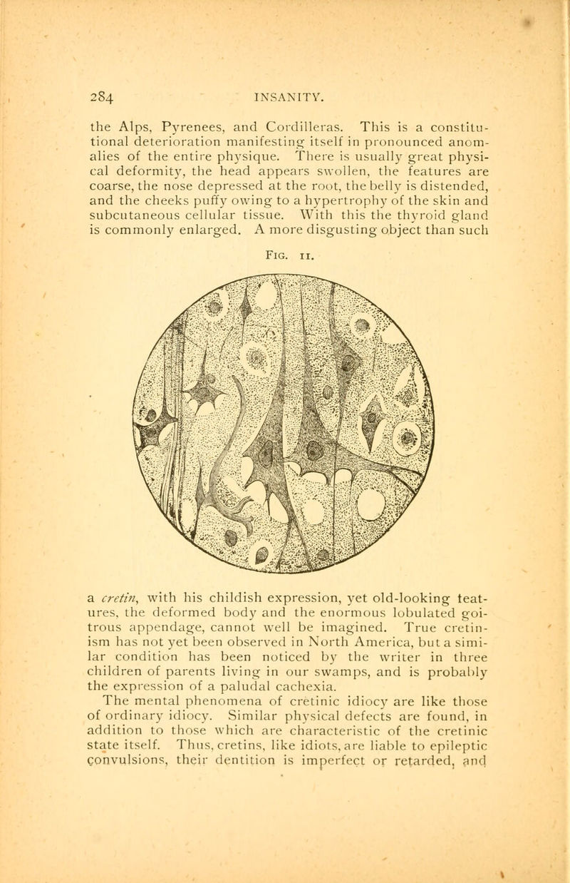 the Alps, Pyrenees, and Cordilleras. This is a constitu- tional deterioration manifesting itself in pronounced anom- alies of the entire physique. There is usually great physi- cal deformity, the head appears swollen, the features are coarse, the nose depressed at the root, the belly is distended, and the cheeks puffy owing to a hypertrophy of the skin and subcutaneous cellular tissue. With this the thyroid gland is commonly enlarged. A more disgusting object than such Fig. ii. a cretin, with his childish expression, yet old-looking feat- ures, the deformed body and the enormous lobulated goi- trous appendage, cannot well be imagined. True cretin- ism has not yet been observed in North America, but a simi- lar condition has been noticed by the writer in three children of parents living in our swamps, and is probably the expression of a paludal cachexia. The mental phenomena of cretinic idiocy are like those of ordinary idiocy. Similar physical defects are found, in addition to those which are characteristic of the cretinic state itself. Thus, cretins, like idiots, are liable to epileptic Convulsions, their dentition is imperfect or retarded, and